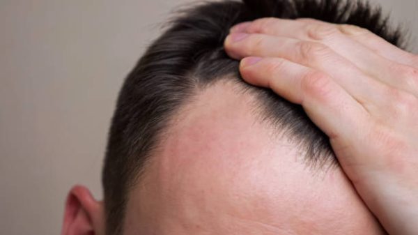 Study finds sugary drinks could be connected to male hair loss